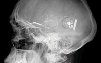 Image: The Alpha IMS light-sensitive subretinal microchip, inductive power supply, and wireless receiver (Photo courtesy of Retina Implant). Image: The Alpha IMS light-sensitive subretinal microchip, inductive power supply, and wireless receiver (Photo courtesy of Retina Implant).